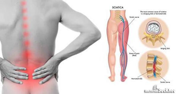 Bệnh đau thần kinh tọa – nguyên nhân, biểu hiện và 3 bài thuốc dân gian chữa khỏi bệnh Bệnh đau thần kinh tọa – nguyên nhân, biểu hiện và 3 bài thuốc dân gian chữa khỏi bệnh