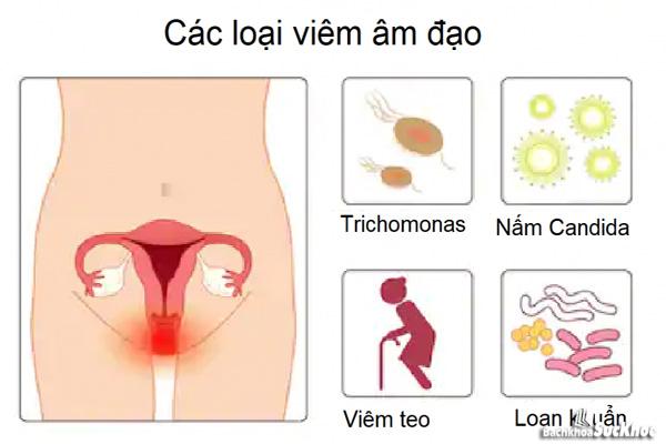 Bệnh viêm âm đạo: Khái niệm, nguyên nhân, triệu chứng, trị liệu, phòng ngừa Bệnh viêm âm đạo: Khái niệm, nguyên nhân, triệu chứng, trị liệu, phòng ngừa