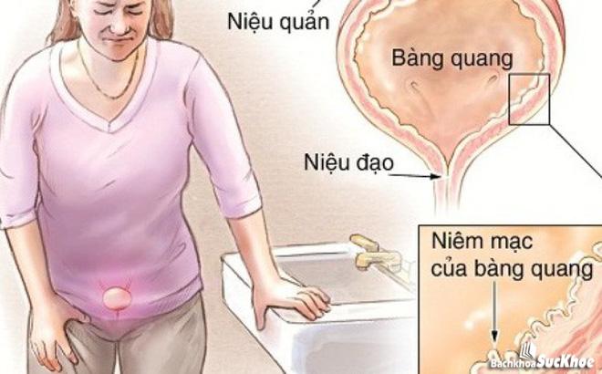 Bệnh viêm bàng quang: Khái niệm, nguyên nhân, triệu chứng, trị liệu, phòng ngừa Bệnh viêm bàng quang: Khái niệm, nguyên nhân, triệu chứng, trị liệu, phòng ngừa