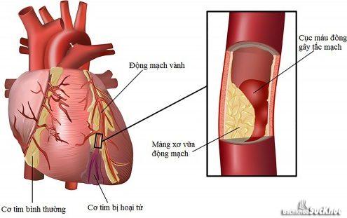 Bệnh viêm cơ tim – Nguyên nhân, các triệu chứng và một số thực phẩm hỗ trợ điều trị bệnh
