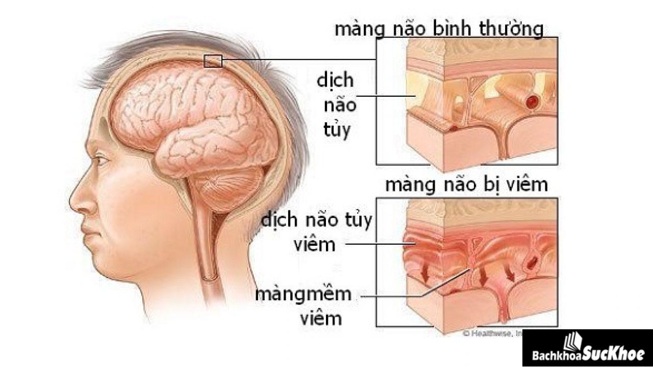 Bệnh viêm màng não do liên cầu: Khái niệm, nguyên nhân, triệu chứng,trị liệu và phòng ngừa 26 Bệnh viêm màng não do liên cầu: Khái niệm, nguyên nhân, triệu chứng,trị liệu và phòng ngừa 10