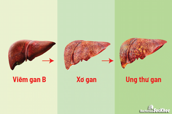 Bệnh xơ gan: Khái niệm, nguyên nhân, biểu hiện, điều trị, cách phòng ngừa Bệnh xơ gan: Khái niệm, nguyên nhân, biểu hiện, điều trị, cách phòng ngừa