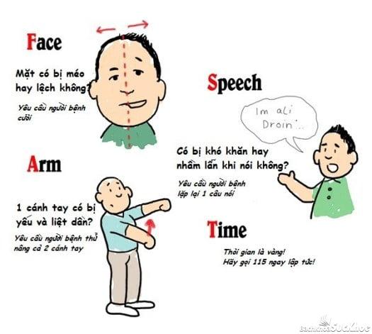 Bệnh đột quỵ: Khái niệm, nguyên nhân, triệu chứng, điều trị, cách phòng ngừa 4 Triệu chứng của bệnh đột quỵ
