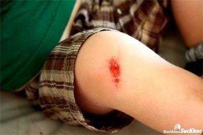 Bệnh nhiễm trùng da: Khái niệm, nguyên nhân, triệu chứng,điều trị và cách phòng ngừa 25 Sử dụng thuốc kháng sinh khi bị xước da