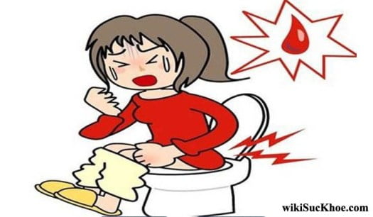 Bệnh đại tiện ra máu: Khái niệm, nguyên nhân, triệu chứng, phòng ngừa 1 Bệnh đại tiện ra máu là gì?