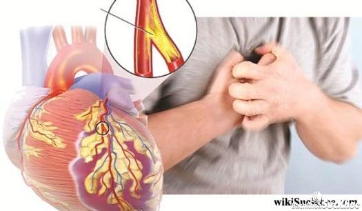 Bệnh đột quỵ: Khái niệm, nguyên nhân, triệu chứng, điều trị, cách phòng ngừa 9