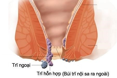 Bệnh trĩ hỗn hợp: Khái niệm, nguyên nhân, triệu chứng, phòng ngừa 1 Bệnh trĩ hỗn hợp là gì?