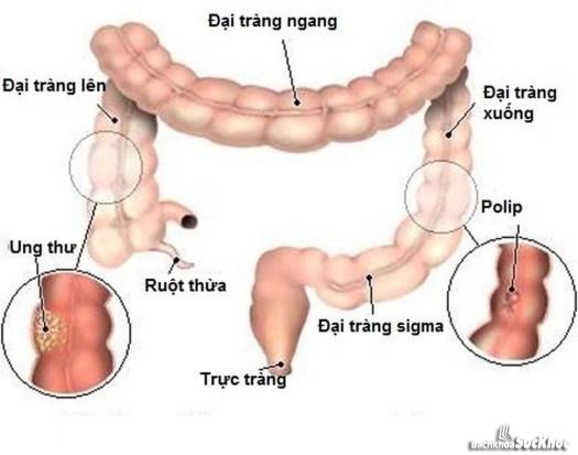 Bệnh ung thư đại trực tràng: Khái niệm, nguyên nhân, triệu chứng, điều trị, phòng chống Bệnh ung thư đại trực tràng: Khái niệm, nguyên nhân, triệu chứng, điều trị, phòng chống