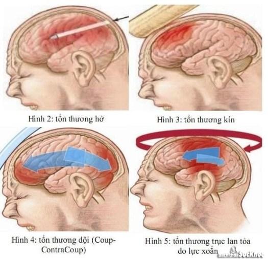 Bệnh chấn thương sọ não: Khái niệm, nguyên nhân, triệu chứng, phòng ngừa Bệnh chấn thương sọ não: Khái niệm, nguyên nhân, triệu chứng, phòng ngừa