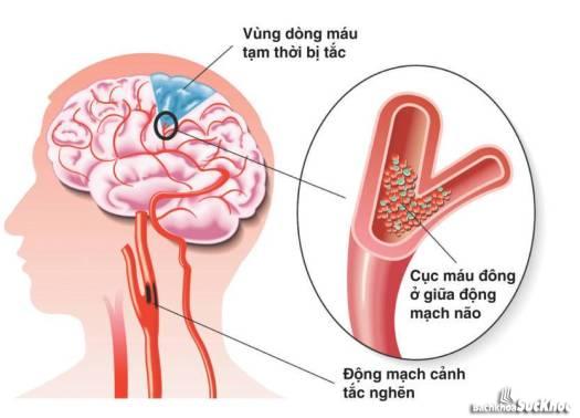 Bệnh mạch máu não: Khái niệm, nguyên nhân, triệu chứng,điều trị và cách phòng ngừa Bệnh mạch máu não: Khái niệm, nguyên nhân, triệu chứng,điều trị và cách phòng ngừa