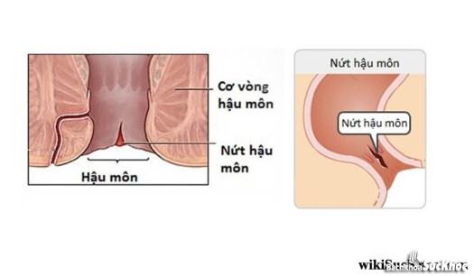 Bệnh nứt hậu môn: Khái niệm, nguyên nhân, triệu chứng và phòng ngừa Bệnh nứt hậu môn: Khái niệm, nguyên nhân, triệu chứng và phòng ngừa