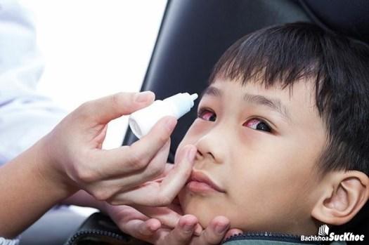 Bệnh đau mắt đỏ: Khái niệm, nguyên nhân, triệu chứng, phòng ngừa 27 Bệnh đau mắt đỏ dễ bị lây lan, truyền nhiễm