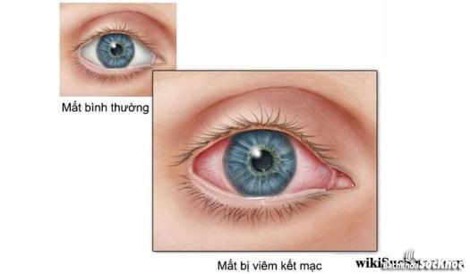 Bệnh kết mạc: Khái niệm, nguyên nhân, triệu chứng, điều trị, cách phòng ngừa 1 Tìm hiểu về căn bệnh kết mạc