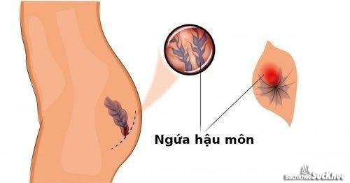 Bệnh ngứa hậu môn: Khái niệm, nguyên nhân, triệu chứng, phòng ngừa 26 Nhiều nguyên nhân gây ra bệnh ngứa hậu môn