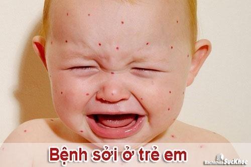 Bệnh sởi: Khái niệm, nguyên nhân, triệu chứng, điều trị, cách phòng ngừa 26 Bệnh sởi là bệnh như thế nào?
