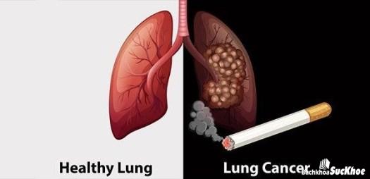 Bệnh ung thư phổi: Khái niệm, nguyên nhân, triệu chứng, phòng ngừa 27 Thuốc lá gây hại tới sức khỏe của mọi người