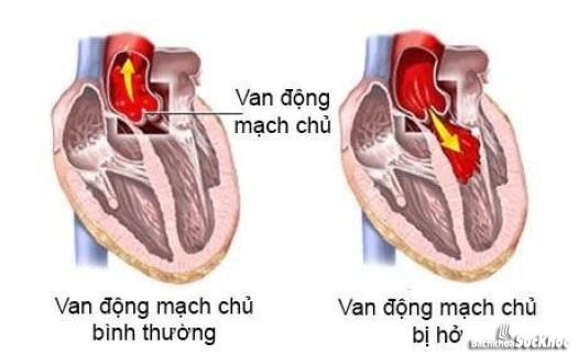 Bệnh van động mạch chủ: Khái niệm, nguyên nhân, triệu chứng, phòng ngừa 27 Bệnh hở van động mạch chủ