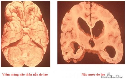 Nguyên nhân chủ yếu gây bệnh