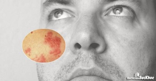 Bệnh zona hạch gối: Khái niệm, nguyên nhân, triệu chứng,điều trị và cách phòng ngừa 27 Bệnh zona hạch gối có nhiều tác động vào cuộc sống người bệnh
