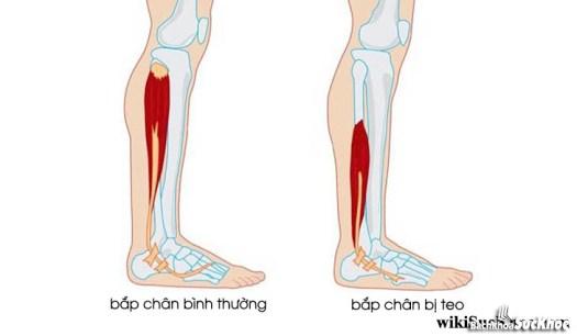 Bệnh teo cơ bắp chân: Khái niệm, nguyên nhân, triệu chứng,điều trị và phòng ngừa 26 Bệnh teo cơ bắp chân là gì ?