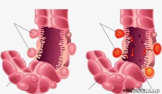 Bệnh tả: Khái niệm, nguyên nhân, dấu hiệu, cách điều trị, phòng tránh 26 Hình ảnh vi khuẩn bệnh tả