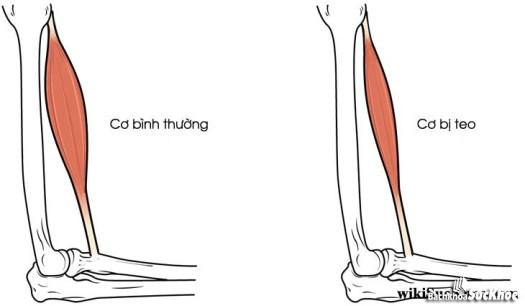 Bệnh teo cơ: Khái niệm, nguyên nhân, triệu chứng, điều trị và cách phòng ngừa 26 Bệnh teo cơ là gì