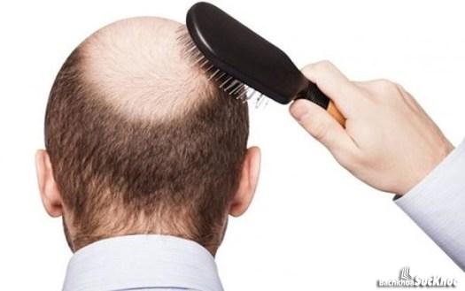 Bệnh rối loạn nội tiết tố: Khái niệm, nguyên nhân, triệu chứng,điều trị và cách phòng ngừa 28 Rụng tóc là dấu hiệu rối loạn nội tiết tố thường gặp ở nam giới