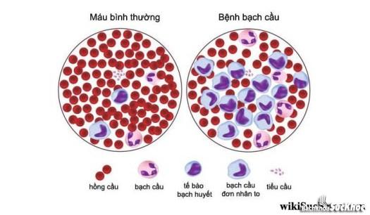 Bệnh bạch cầu cấp: Khái niệm, nguyên nhân, triệu chứng,điều trị và cách phòng bệnh 26 Hình ảnh mô tả bệnh bạch cầu cấp