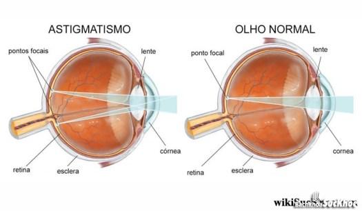 Bệnh giác mạc: Khái niệm, nguyên nhân, triệu chứng, điều trị, cách phòng ngừa 26 Bệnh giác mạc