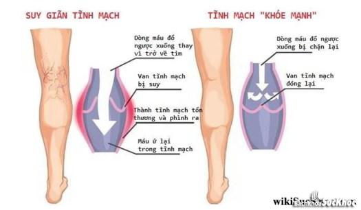 Bệnh giãn tĩnh mạch chi dưới: Khái niệm, nguyên nhân, triệu chứng,điều trị và cách phòng ngừa 26 Bệnh suy giãn tĩnh mạch chi dưới