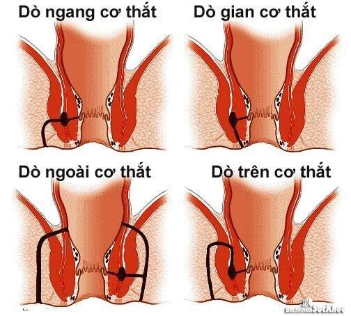 Bệnh rò hậu môn: Khái niệm, nguyên nhân, triệu chứng, phòng ngừa 1 Các loại rò hậu môn mà các bạn cần biết