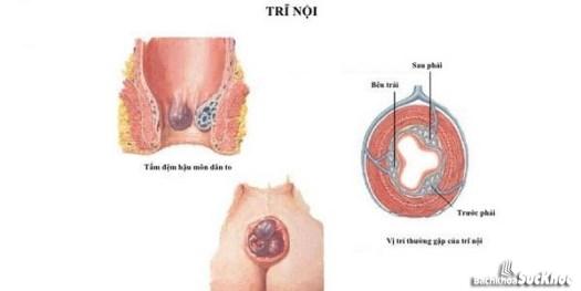 Bệnh trĩ nội: Khái niệm, nguyên nhân, dấu hiệu và cách phòng chống 9