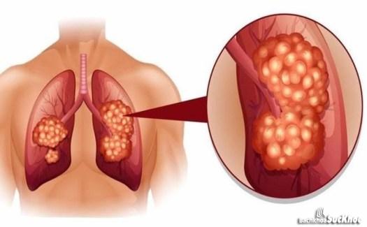 Bệnh ung thư phổi: Khái niệm, nguyên nhân, triệu chứng, phòng ngừa 26 Bệnh ung thư phổi gây hại tới tính mạng con người