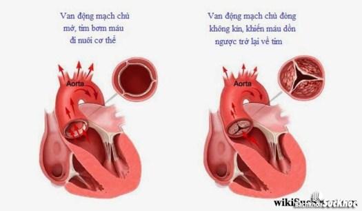 Bệnh van động mạch chủ: Khái niệm, nguyên nhân, triệu chứng, phòng ngừa 26 Bệnh hẹp van động mạch chủ