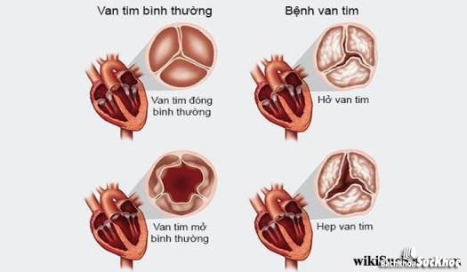 Bệnh van tim: Khái niệm, nguyên nhân, triệu chứng, phòng ngừa 26 Bệnh van tim