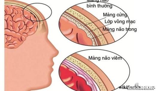 Bệnh viêm màng não do tụ cầu: Khái niệm, nguyên nhân, triệu chứng,điều trị và cách phòng ngừa Bệnh viêm màng não do tụ cầu: Khái niệm, nguyên nhân, triệu chứng,điều trị và cách phòng ngừa