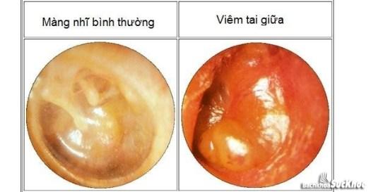 Bệnh viêm tai giữa: Khái niệm, nguyên nhân, triệu chứng, phòng ngừa 26 Tìm hiểu về bệnh viêm tai giữa