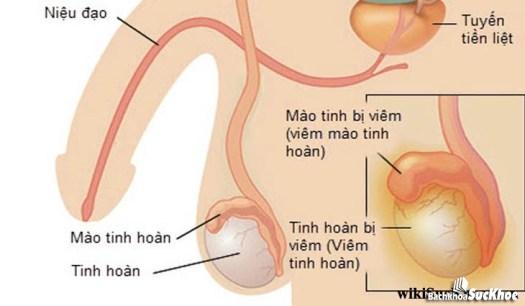 Bệnh viêm tinh hoàn: Khái niệm, nguyên nhân, triệu chứng, điều trị và cách phòng tránh 26 Bệnh viêm tinh hoàn gây ảnh hưởng nghiêm trọng đến hoạt động sinh lí ở nam giới