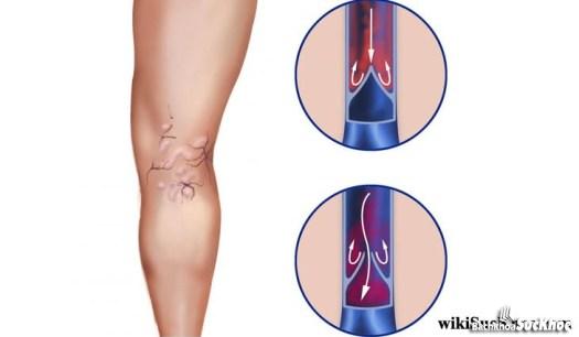 Bệnh viêm tĩnh mạch: Khái niệm, nguyên nhân, triệu chứng,điều trị và cách phòng ngừa 26 Bệnh viêm tĩnh mạch là gì