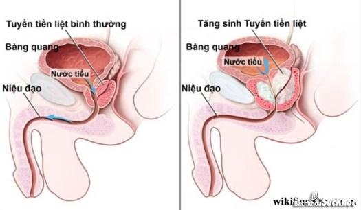 Bệnh viêm tuyến tiền liệt: Khái niệm, nguyên nhân, triệu chứng và cách điều trị 1 Bệnh viêm tuyến tiền liệt là gì?