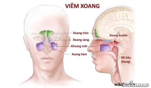 Bệnh viêm xoang: Khái niệm, nguyên nhân, triệu chứng, phòng ngừa 26 Bệnh viêm xoang là gì?