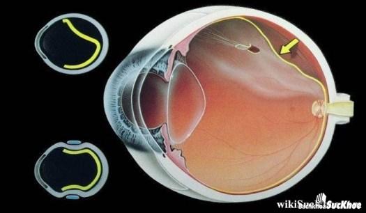 Bệnh võng mạc: Khái niệm, nguyên nhân, triệu chứng, điều trị và cách phòng ngừa 1 Bệnh võng mạc
