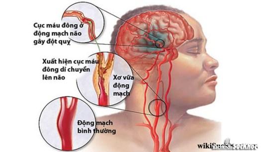 Bệnh xuất huyết não: Khái niệm, nguyên nhân, triệu chứng, điều trị, cách phòng ngừa 26 Bênh xuất huyết não rất nguy hiểm