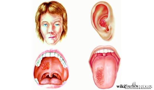 Bệnh zona hạch gối: Khái niệm, nguyên nhân, triệu chứng,điều trị và cách phòng ngừa 26 Bệnh zona hạch gối là gì