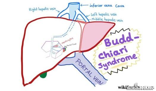 Hội chứng Budd – Chiari: Khái niệm, nguyên nhân, biểu hiện,điều trị và cách phòng ngừa 26 Hội chứng Budd – Chiari chủ yếu xảy ra ở người lớn