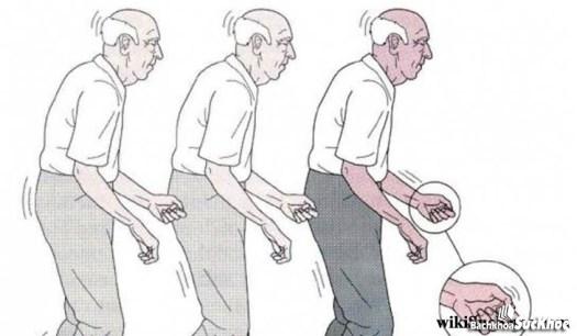 Hội chứng Parkinson: Khái niệm, nguyên nhân, triệu chứng, điều trị, cách phòng ngừa 26 Hội chứng bệnh parkinson