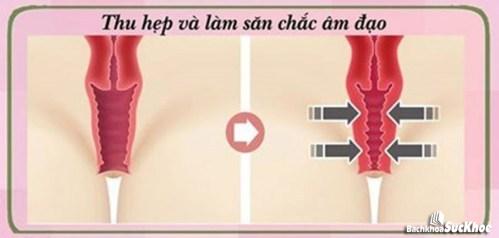 Những điều cần biết về việc thu nhỏ âm đạo 10