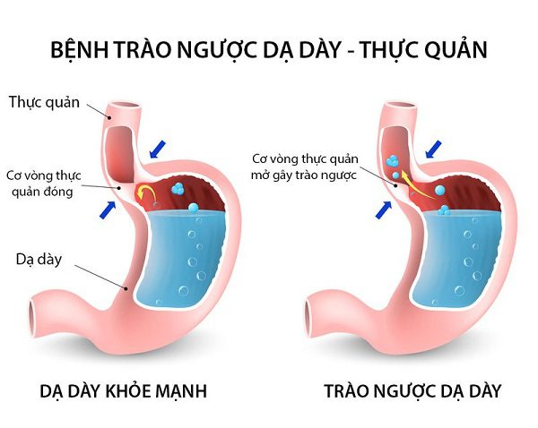 Bi-quyet-tu-nhien-giam-trao-nguoc-thuc-quan-da-day Bi-quyet-tu-nhien-giam-trao-nguoc-thuc-quan-da-day