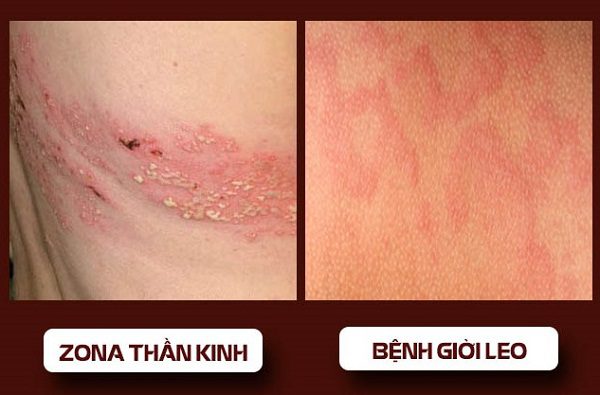 Nên phân biệt rõ bệnh rona thần kinh và giờ leo Dong-y-tri-benh-gioi-leo