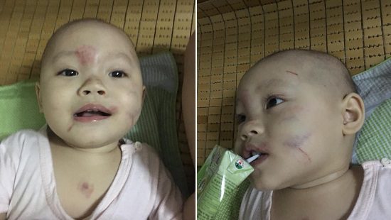 Mẹ bé Đ. cho biết đêm 23/10 khi ngủ cháu bị quấy khóc và giật mình nhiều. Ảnh: Gia đình cung cấp Vụ bé gái 14 tháng tuổi bầm tím mặt mũi sau ngày đầu đến trường: Cô giáo không biết cháu bị bạn cắn?